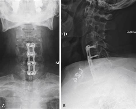 C1 Lateral Mass And C2 Pedicle Screw Fixation Musculoskeletal Key
