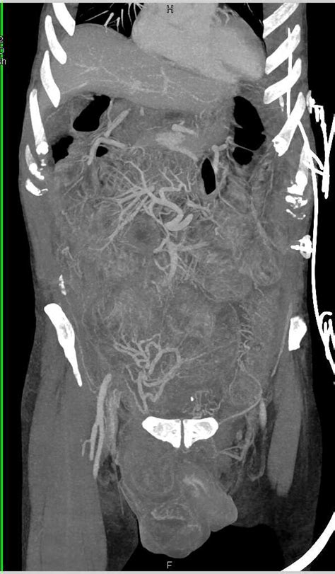 Incarcerated Inguinal Hernia With Perforation And Pneumoperitoneum