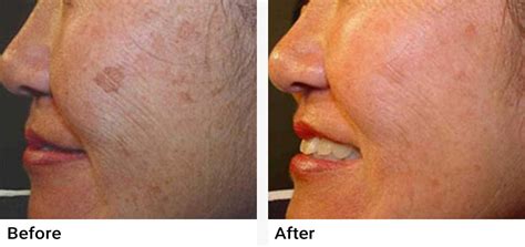 Ipl Photofacial Correct Skin Damage Reduce Discoloration