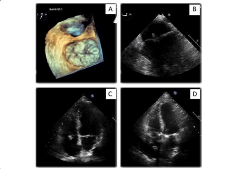 Echocardiographic Images Of The Patient With Mitral And Tricuspid Ie A