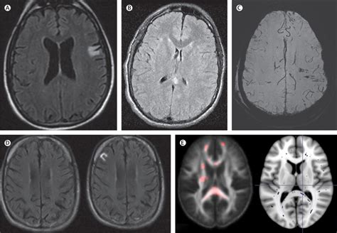 Diagnosis Prognosis And Clinical Management Of Mild Traumatic Brain