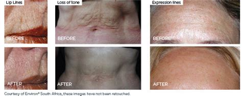 Collagen Stimulation Therapy Skin3 Salon
