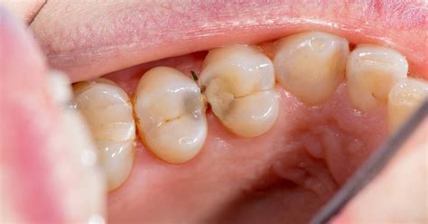 Las Caries Interdentales Un Asesino Dental Oculto Clínica Dental De