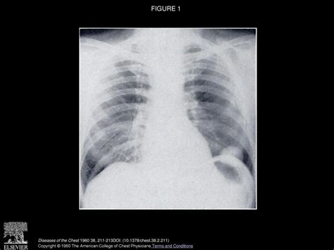 Unusual Coin Lesion In The Lung Ppt Download