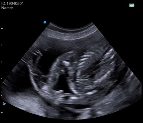 48 Tiny Dog Pregnancy Scan At 5 Weeks Photo 8k Ukbleumoonproductions