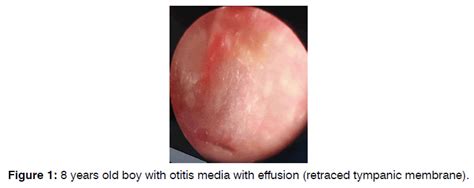 Tympanic Membrane Otitis Media Effusion