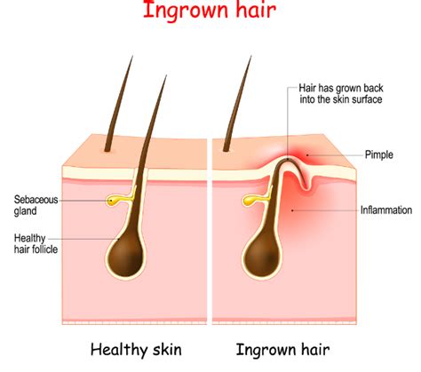Ingrown Hairs Causes Treatment And Prevention