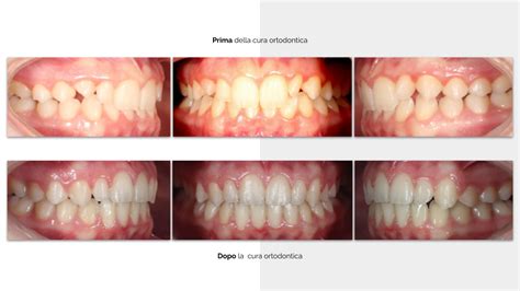 Studio Dentistico Balestro Malocclusione Di II Classe Div 2