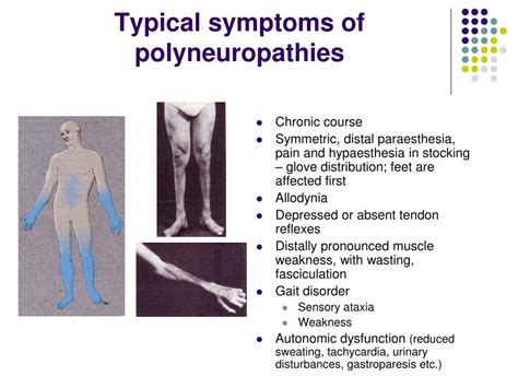 Ppt Polyneuropathies Mononeuropathies Motoneuron Diseases Powerpoint