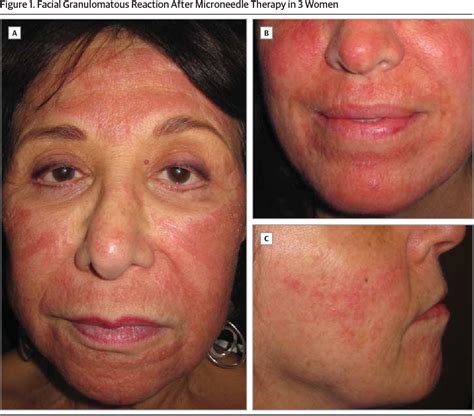Pdf Facial Allergic Granulomatous Reaction And Systemic