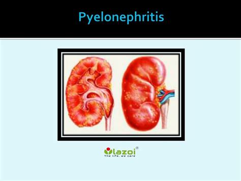 Ppt Pyelonephritis Causes Symptoms Daignosis Prevention And