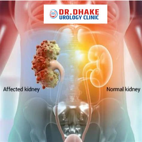 Guidelines For The Management Of Kidney Cysts Dr Rajesh Dhake