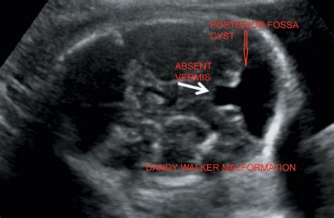 Dandy Walker Ultrasound