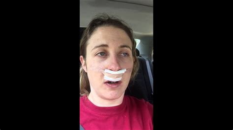 30 Minutes After Septoplasty And Bilateral Turbinate Reduction Surgery