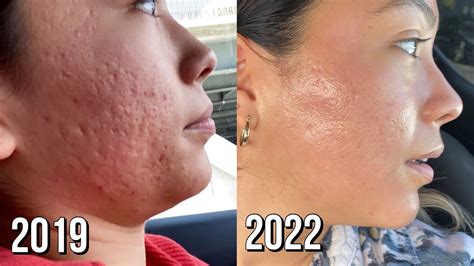 microneedling session 8 before after youtube