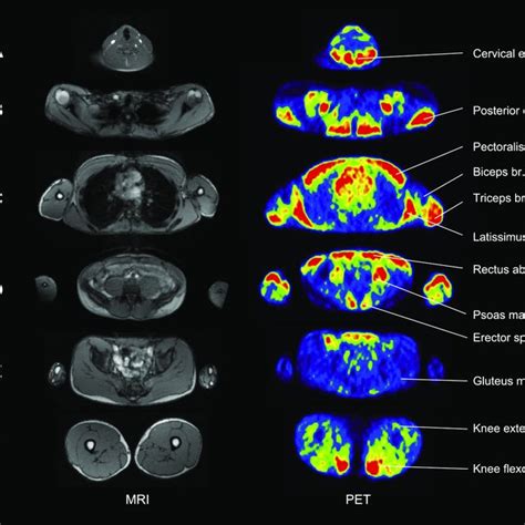 Positron Emission Tomography Pet Images Three Dimensional 3d