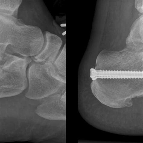 Pre And Post Operative Radiographs Demonstrating Percutaneous Fracture