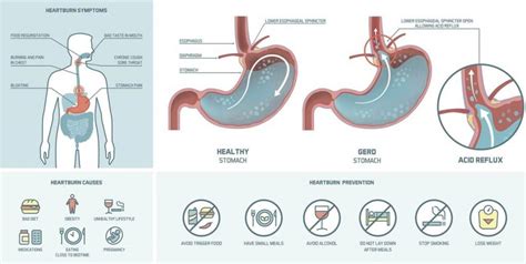 Gastroesophageal Reflux Disease Gerd Bims Hospital