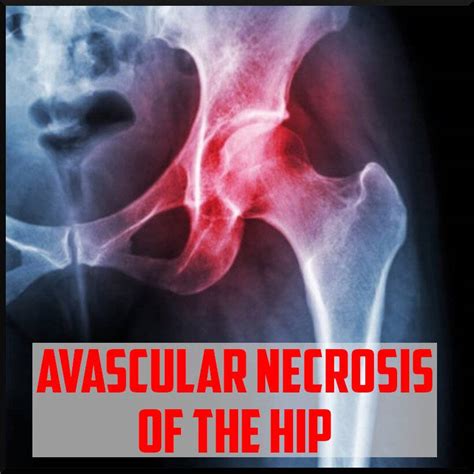 Avascular Necrosis Of The Femoral Head Background Diagnosis And