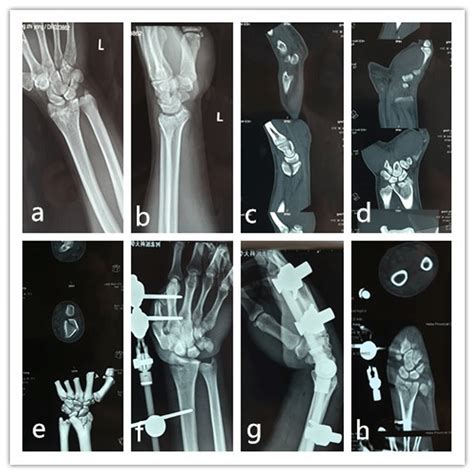 A Male Patient 44 Years Old Sustained Intra Articular Fracture Of