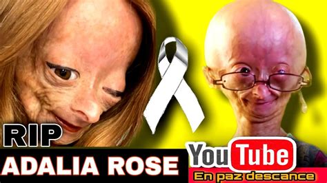 Adalia Rose Williams Fallece La Youtuber Influencer Sufría Síndrome De Progeria Hutchinson