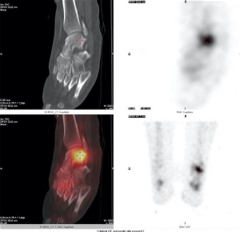 24 métastases hépatiques multiples d'un cancer du colon. Scintigraphie osseuse Aubagne La CasamanceScintigraphie ...