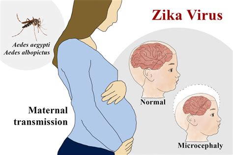 Zika Virus Associated Microcephaly When A Pregnant Woman Is Infected