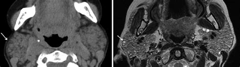 Early Sjogrens Syndrome Axial Computed Tomography A And Axial