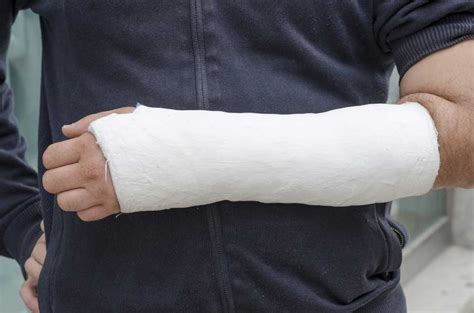 Plaster Cast Definition And Meaning Collins English Dictionary