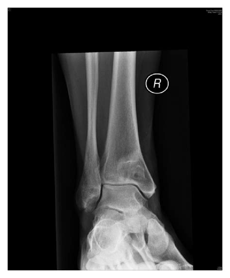 Intraosseous Ganglion Of The Distal Tibia Clinical Radiological And