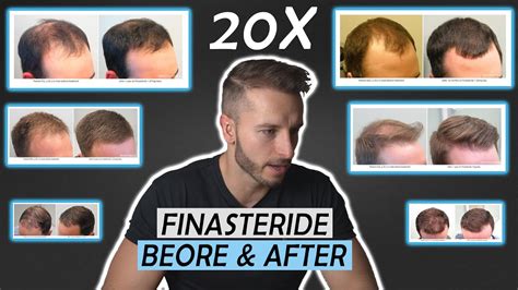 20 Finasteride Before And After Results Nw1 Nw5nw6 Youtube