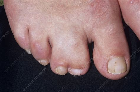 Webbed Toes Stock Image M3500291 Science Photo Library