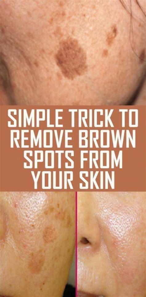 Brown Spots On Face Image By Mary Lorentzen On Makeup Info Ideas