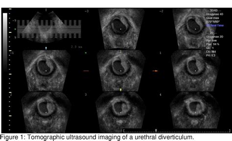Figure 1 From The Use Of 4 Dimensional Ultrasound And Tomographic
