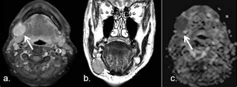 Cancers Free Full Text Utility Of Mri Diffusion Techniques In The