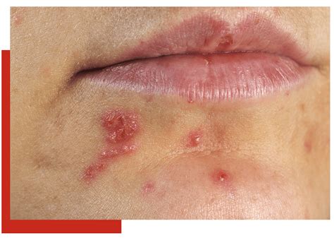 Herpes Around The Lips Pictures