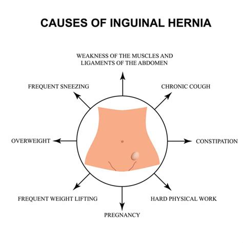 Types Of Hernia In Adults Rolling Hills Medical