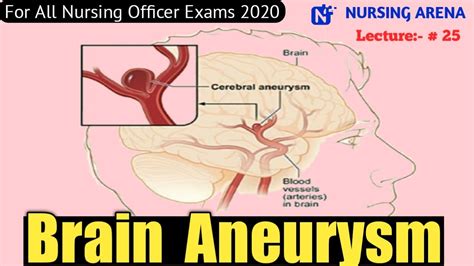 Brain Aneurysm Cerebral Aneurysm Symptoms Causes Nursing