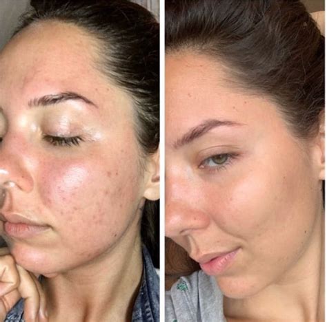 Before And After Dermaroller Derma Roller Microneedling Skin Care