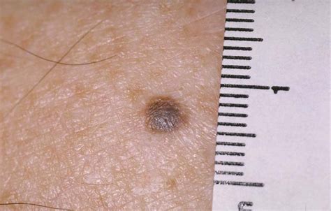 How A Doctor Mistakes Melanoma For Seborrheic Keratosis Scary Symptoms Hot Sex Picture