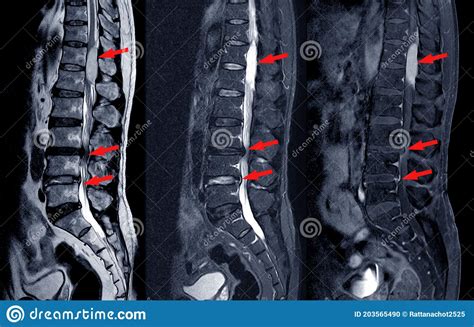 MRI Scan Of Lumbar Spines Of A Patient Finding Spinal Mass At Lt Side