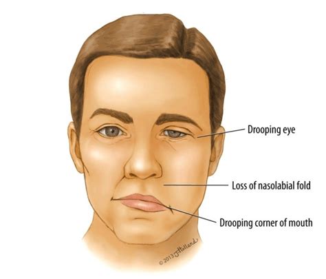 Everything About Bells Palsy News Dentagama