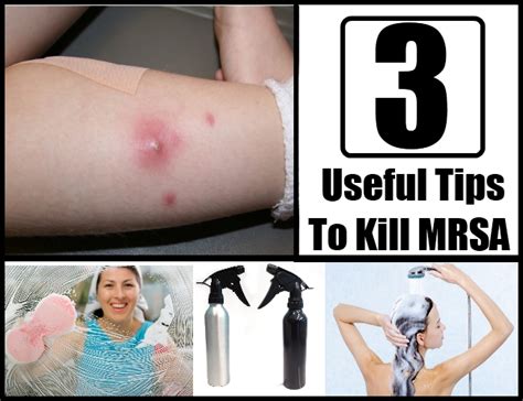 3 Useful Tips To Kill Mrsa Natural Home Remedies And Supplements