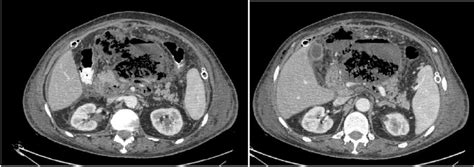 Abdominopelvic Ct Scan After Extraperitoneal Collection Drainage