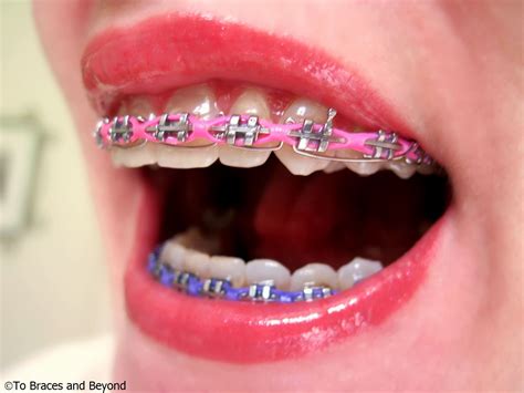 Pin Di Loveandpeach Su Silver Smile Close Up Denti