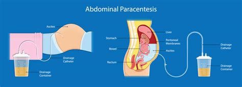 Abdominal Paracentesis Procedure