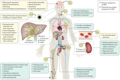 Wilsons Disease Pathogenesis And Clinical Features Wilsons