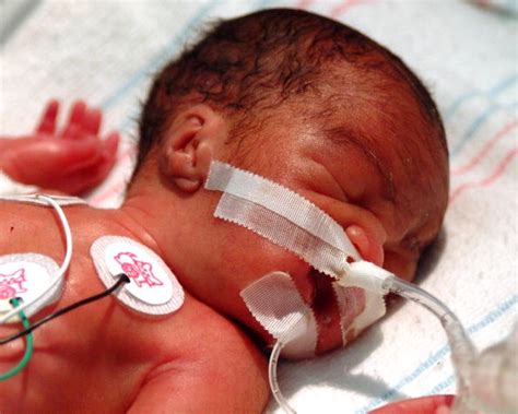 Extremely Premature Babies More Likely To Survive Now Youth Health