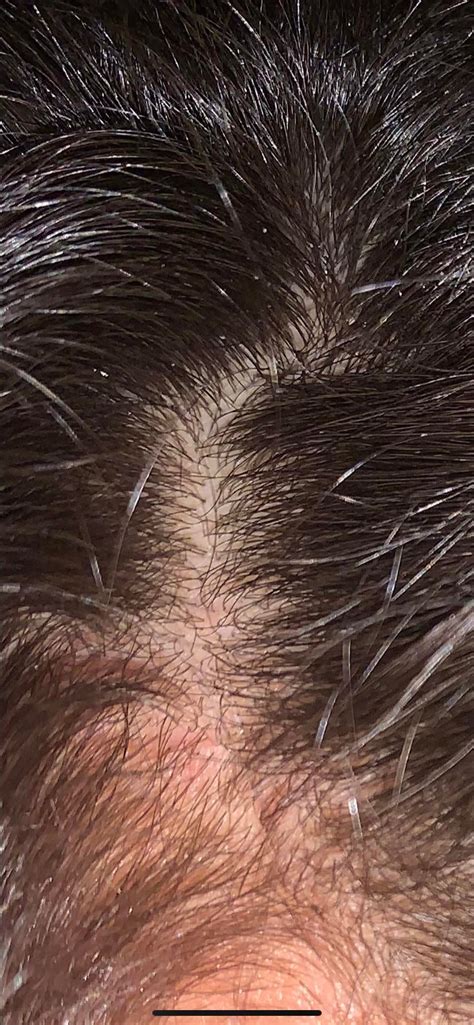 Do These Red Bumps On My Scalp Mean My Aga Is Scarring Anyone