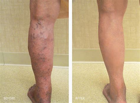 What Is The Success Rate Of Varicose Vein Surgery Question Answer
